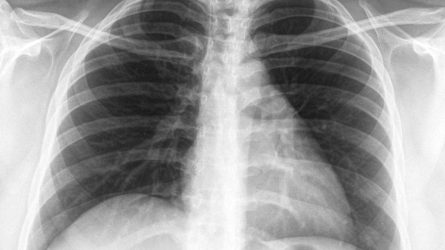 Безплатни консултации за туберкулоза до 27 март в София