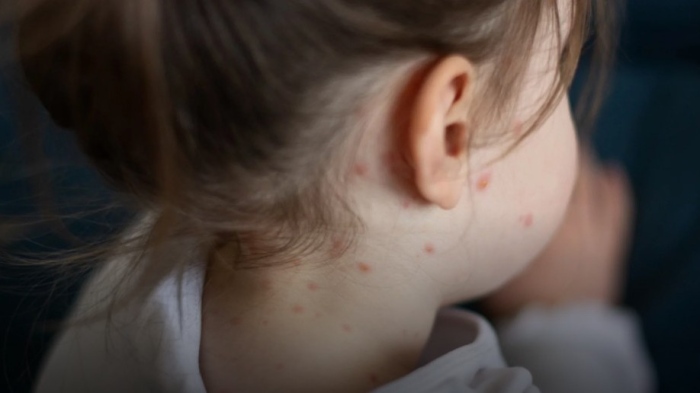 Случаите на морбили скочиха с 1/4 за 4 дни: В 3 нови области има болни