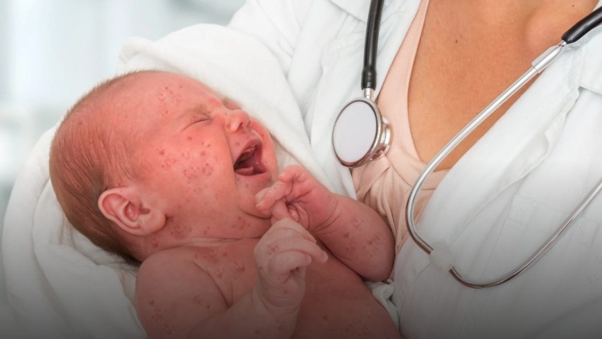 Няма епидемия, а епидемичен взрив от морбили: Проф. Ива Христова с последни данни за заразата