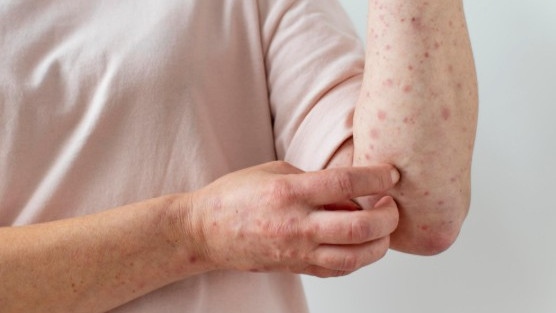 Педиатър: Един болен от морбили може да зарази почти всички неимунизирани в затворено помещение