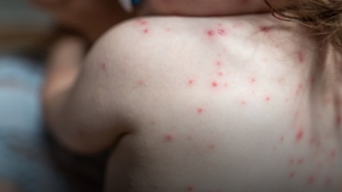Почти 150 случая на морбили: Заради епидемията ударно са поставени близо 20 000 ваксини